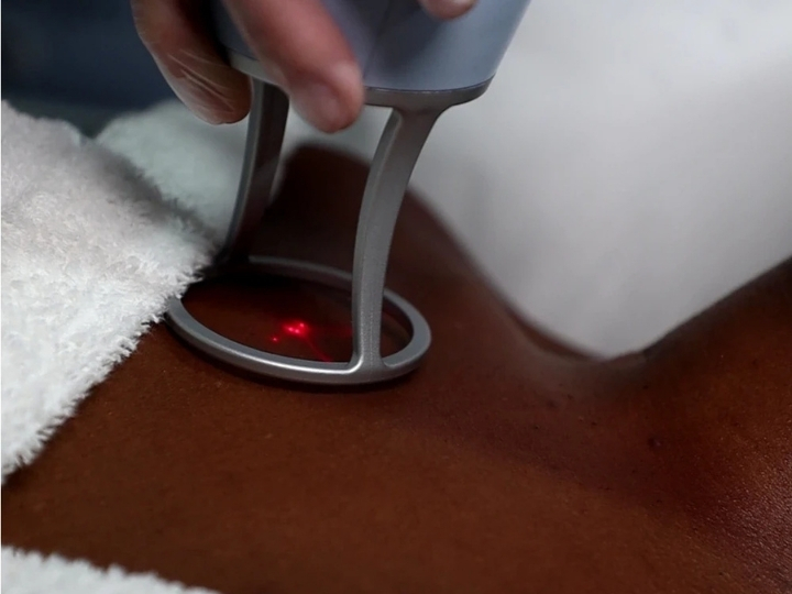 Tratamento com laser Lavieen corporal nas costas de paciente na Ollige Clinic