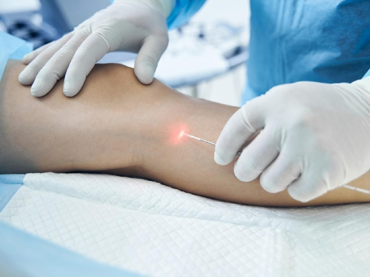 Aplicação de endolaser corporal na região abdominal na Ollige Clinic Avenida Paulista