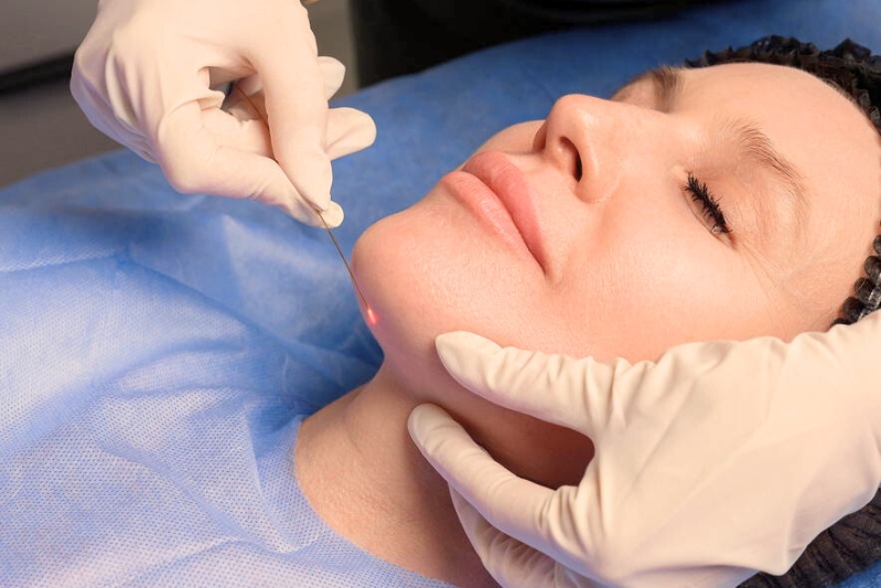 Mulher em clínica estética recebendo aplicação de endolaser facial para rejuvenescimento com tecnologia a laser