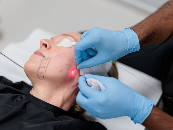 Aplicação de endolaser facial em paciente na Ollige Clinic Avenida Paulista