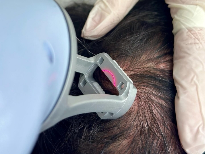 Aplicação do laser Lavieen capilar no couro cabeludo de paciente na Ollige Clinic