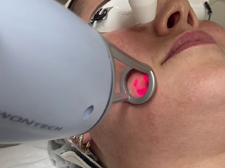 Paciente recebendo tratamento com laser Lavieen facial na Ollige Clinic
