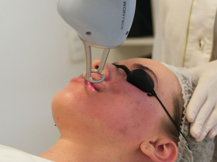 Mulher recebendo tratamento de laser Lavieen facial na Ollige Clinic, indicado para manchas e rejuvenescimento da pele