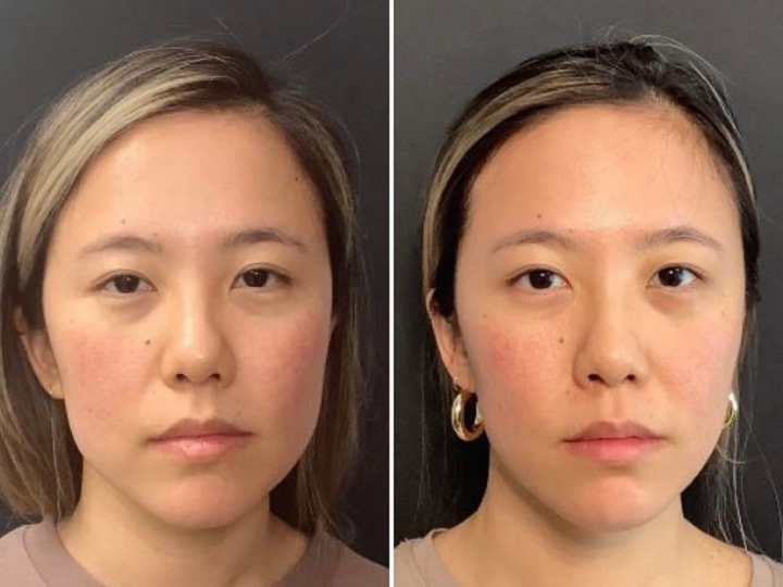 Comparação facial de paciente mostrando melhora na tensão muscular após botox para bruxismo em Avenida Paulista