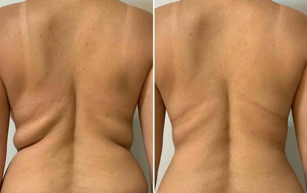 Comparação de antes e depois do endolaser corporal evidenciando redução de flacidez e melhora do contorno corporal