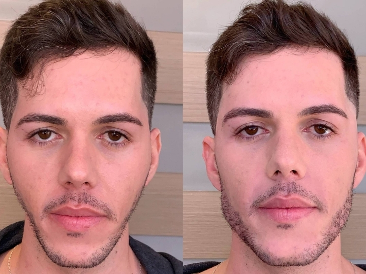 Comparação do antes e depois da harmonização facial mostrando melhora na simetria e rejuvenescimento facial na Avenida Paulista