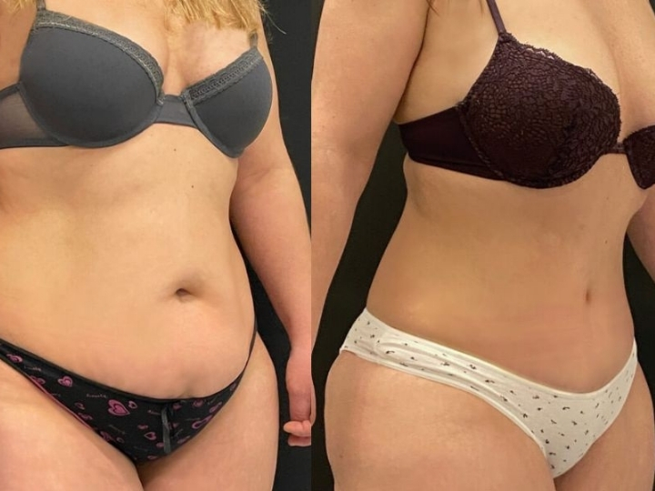Comparação do antes e depois do Hipro Corporal mostrando melhora da firmeza e contorno corporal na Avenida Paulista