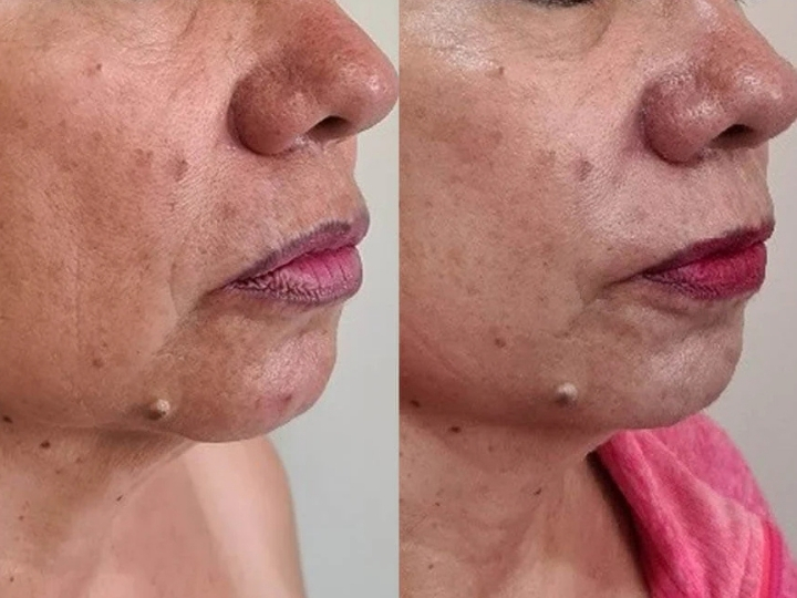 Comparação do antes e depois do tratamento Hipro Facial na Avenida Paulista, mostrando melhora na firmeza e textura da pele