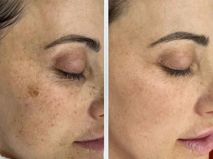 Resultado antes e depois do Laser Lavieen Corporal na Ollige Clinic, Avenida Paulista