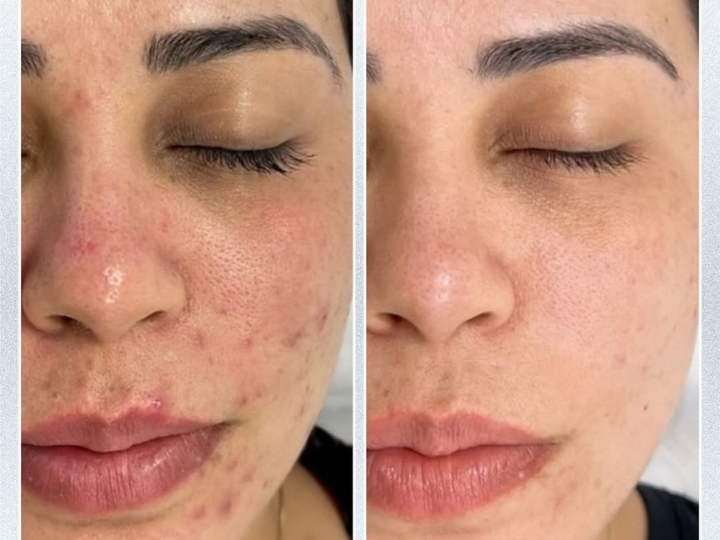 Comparativo de antes e depois do tratamento com laser Lavieen facial, mostrando melhora em manchas e textura da pele