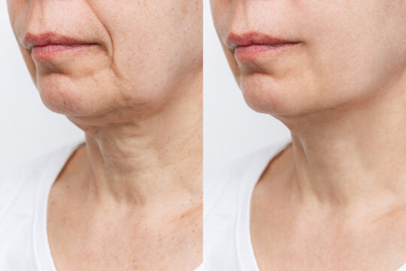 Antes e depois do tratamento com endolaser facial mostrando lifting e melhora da flacidez no contorno do rosto